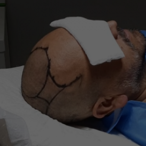 ¿El implante capilar duele?